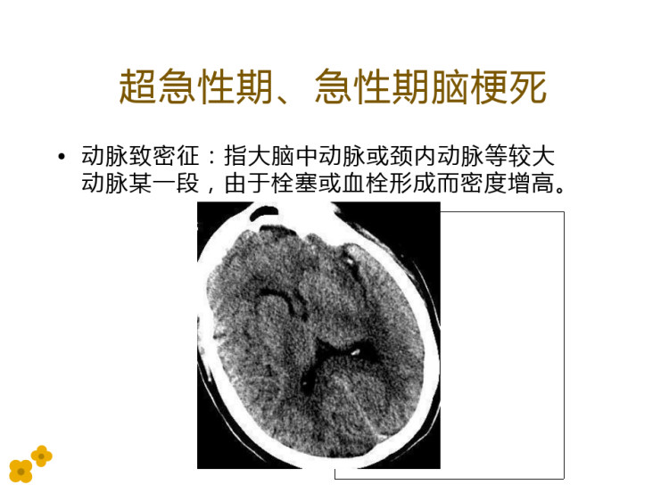 急性脑血管病CT征象分析PPT