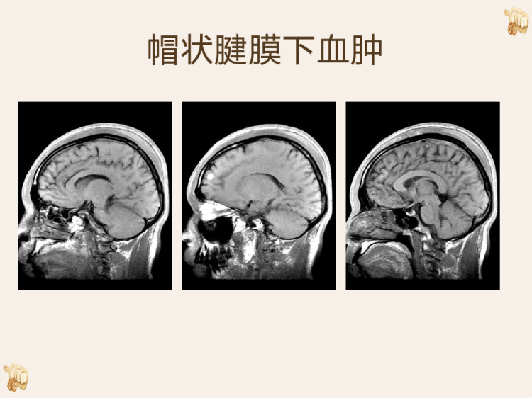 颅脑外伤急诊CT诊断PPT